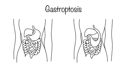 Wall Mural - Gastroptosis