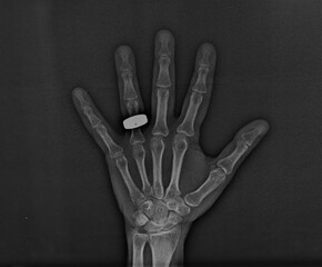 X-ray of a human hand. He is wearing a ring on his left hand. The hand is intact and has no injury.
