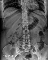 Diagnostic Abdomen X-ray (AP): Common Findings