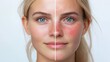 © ECLIVN - Stark Visual Contrast Between Flawless Skin and Hives Inflammation on a Woman's Face