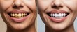 © Qbertstudio - Showcases dramatic smile transformation with teeth whitening procedure highlighting enhanced appearance and improved confidence  Represents dental aesthetics
