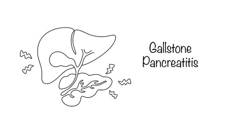 Wall Mural - Gallstone Pancreatitis