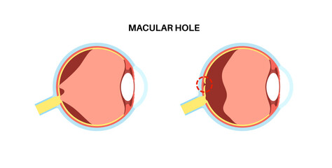 Canvas Print - Macular hole disease