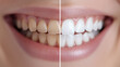 © Robert Kneschke - Close-up of a smiling woman's mouth showing before and after teeth whitening process with noticeable difference