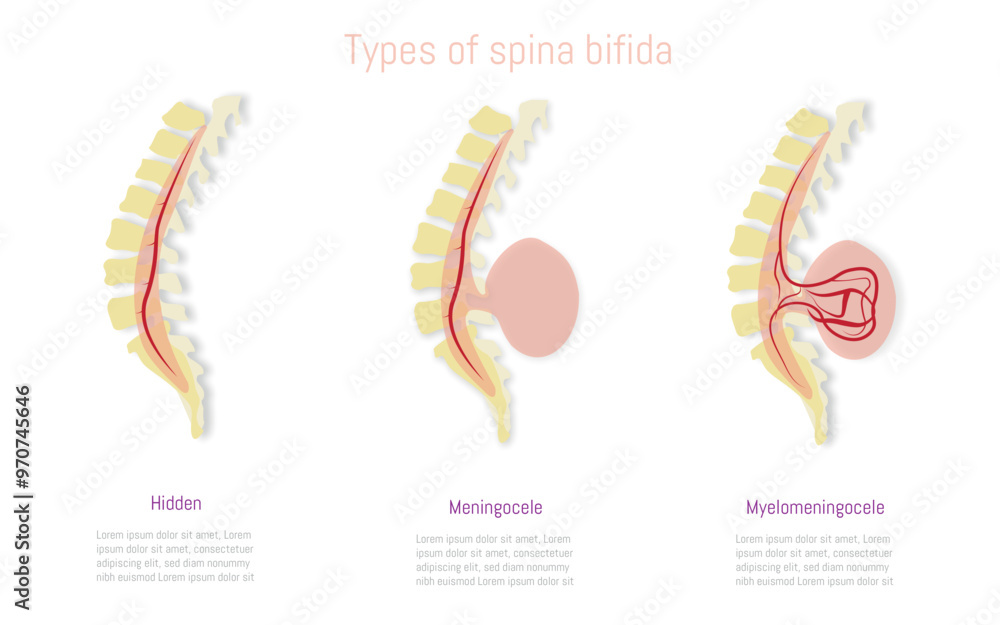 medical-illustration-depicting-types-of-spina-bifida-hidden