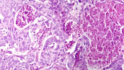 Poster - Light microscopy of lung adenocarcinoma, a malignant tumor originating from glandular cells in the lung. Histologically, it shows atypical glandular structures, and increased mitotic activity.