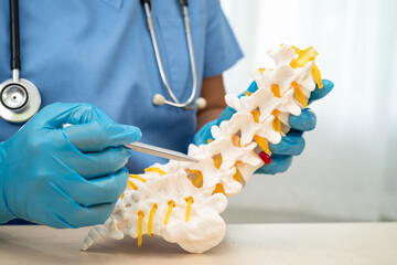 doctor holding lumbar vertebrae spine skeleton bone and spinal nerve with displaced herniated disc f