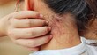© Rung Kh - portrait the rash, hives, allergy and inflammation skin, reaction and urticaria, scar and acne, irritation and dermatitis, infection and eczema, dermatology and allergic on the neck of the woman.