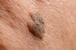 © Tosh - Close-Up of Brown Seborrheic Keratosis (Seborrhoeic wart, Basal cell papilloma, Senile wart) Skin Growth on Cheek