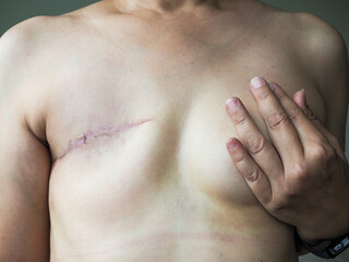 Total Mastectomy - scar of unrecognized woman from Mastectomy operation , one of the breast cancer treatment, one of the breast cancer treatment