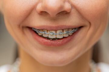 Close up portrait of happy Caucasian young woman showing teeth with braces, having fun, laughing, looking at camera outdoors on urban city street. Toothy smiling. Pretty girl satisfied with dentistry