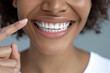 © Valeriia - Stomatology dentistry concept. African-American beautiful female smile after white teeth pointing finger on healthy whitening procedure. Dental oral care