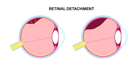 Canvas Print - Retinal detachment eye disease