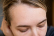 © leroy - Bald patches on the head of a young woman. Hair loss in the temporal area of the head.