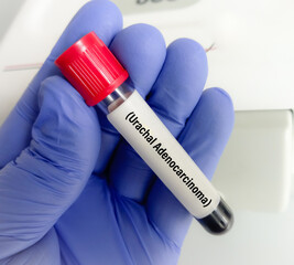 Sticker - Blood sample for Urachal cancer or Urachal carcinoma blood test(CEA, CA19-9, CA125, CA15-3) , a rare type of non urothelial malignancy, that arises from the urachal ligament.