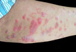 © Zay Win Htai - A raised, red, target like rash on the skin or mucous membranes characteristic of erythema multiforme