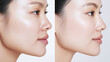 © Luluraschi - an Asian woman's face before and after pigmentation treatment