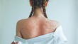 © ryodimas - A photographic image of the back of a person with a braided hairstyle. The skin is dotted with numerous small, reddish-pink bumps or lesions. The person is wearing a white garment, possibly a shirt