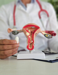 Wall Mural - Model of female reproductive system and suppository medical tablet