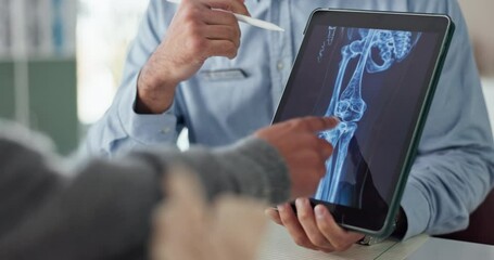 Poster - Osteoporosis, consultant and xray with tablet screen and hands for medical, report or treatment. Doctor, medicine or synthetic stem cell therapy with people and bone marrow transplant breakthrough