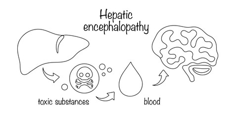 Wall Mural - Hepatic encephalopathy