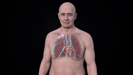 Canvas Print - A man with lungs affected by secondary tuberculosis, 3D animation.