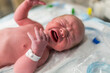 © Cavan Images - Newborn Baby With Vitamin K in Eyes On Warming Table