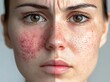© atar - Before and After,  Woman's Face with Acne and Scars, Skin Care and Treatment