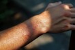 © Boinah - A close-up of a person's arm showing skin irritation or marks.