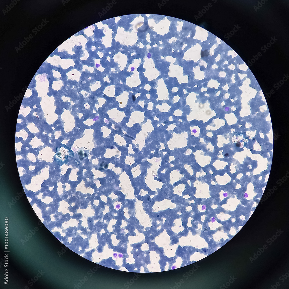Blood picture of Normocytic normochromic anemia. Complete blood cells ...