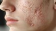 © Alpha - Adult male with severe acne in the before image, post-treatment skin is clear and fresh Emphasizing natural remedies in a calm, serene environment