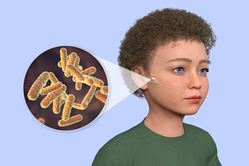 Sticker - Otitis media in a child, 3D illustration