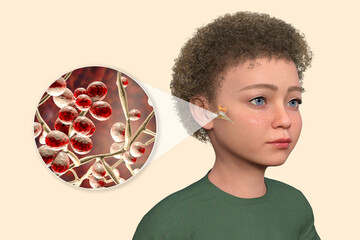 Sticker - Otitis media in a child, 3D illustration