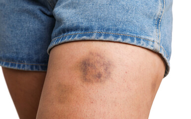 Poster - Woman with bruise on leg against white background, closeup