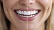 © Sunshine - Close-Up of Smiling Woman's Teeth Before and After Whitening Treatment, Showing Dental Health and Cosmetic Improvement