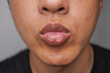© Rizky - Close up photo of A man suffering from chapped lips. Concept for skincare and oral disease.