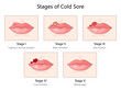 © Oleksandr Pokusai - cold sore, from the initial tingling sensation to blister formation, ulcer eruption, crusting, and healing diagram hand drawn schematic vector illustration. Medical science educational illustration