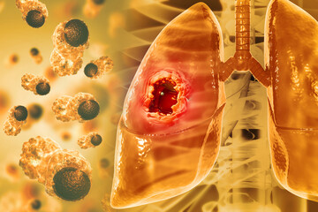 Wall Mural - Medical Illustration showing lung cancer or bronchial carcinoma. 3d illustration