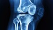 © Leo - A high-resolution X-ray image of a human knee joint, highlighting the intricate details of the bone structure and surrounding tissues, perfect for medical, healthcare, and educational purposes