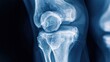 © Leo - A high-resolution X-ray image of a human knee joint, highlighting the intricate details of the bone structure and surrounding tissues, perfect for medical, healthcare, and educational purposes