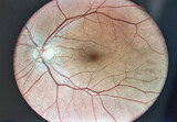 Wide angle retinal fundus imaging closeup.
