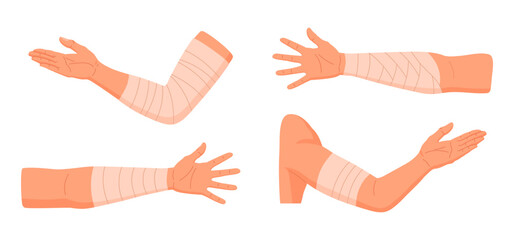 injured human arms. bandaged elbows and forearms, damaged arm parts, emergency treatment for bones f