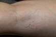 © TAMER YILMAZ - A woman has varicose veins on her thighs. Varicose veins in the leg.