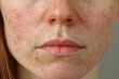 © NatthaphonSiri - Close-up of a woman's face with acne scars, freckles, and red bumps.