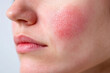 © Varitnan - Close-up of a Red Skin Rash on a Woman's Face.
