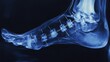 © Prostock-studio - An X-ray displays a human foot demonstrating surgical hardware, including pins and screws, used in corrective surgery after a severe injury, highlighting the intricate work of orthopedic medicine.