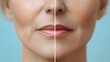 © Alpha - Detailed infographic on the causes of wrinkles around the mouth, paired with real before-and-after comparisons showing smoother skin post-treatment