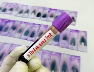 Doctor holding blood sample tube for Beta Thalassemia test with laboratory background.