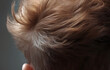 © wathanya - Scalp, hair loss, thinning hair