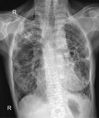 Naklejka na meble Chest X-ray for Visualizing Trachea, Bronchi, and Lung Parenchyma in Respiratory Disease Assessment